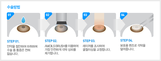 수술방법 : STEP 01. 안약을 점안하여 
							마취하며 수술 중 통증은 전혀 없습니다. STEP 02. AMOILS BRUSH를 이용하여 가장 안전하게 각막 상피를 제거합니다. STEP 03. 레이저를 조사하여 굴절이상을 교정합니다. STEP 04. 보호용 렌즈로 각막을 덮어줍니다.